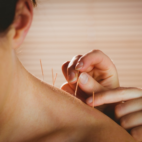 acupuncture-elements-physiotherapy-and-rehabilitation-Oshawa-ON