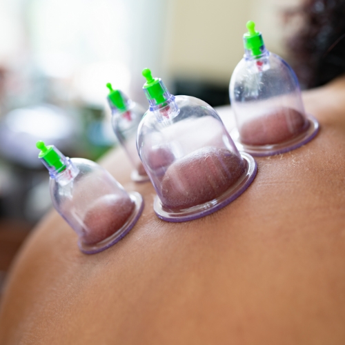 cupping-therapy-elements-physiotherapy-and-rehabilitation-Oshawa-ON
