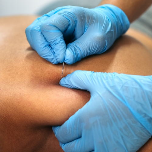 dry-needling-elements-physiotherapy-and-rehabilitation-Oshawa-ON