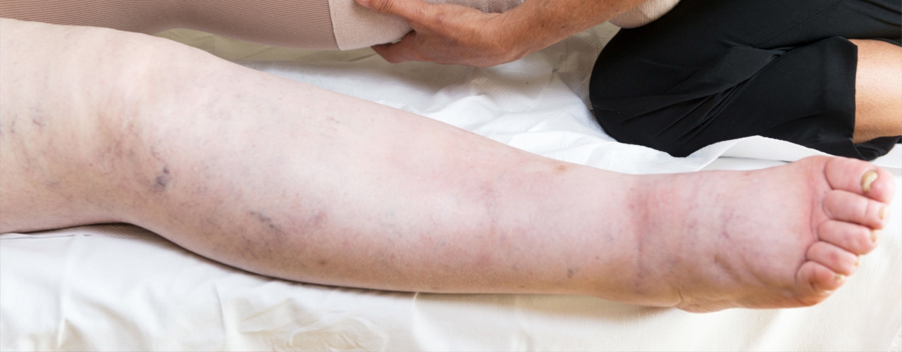 lymphedema-Elements-Physiotherapy-and-Rehabilitation-North-Oshawa-ON