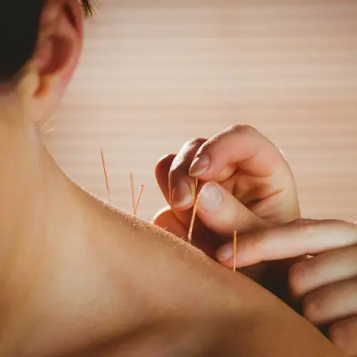 acupuncture-Treatment